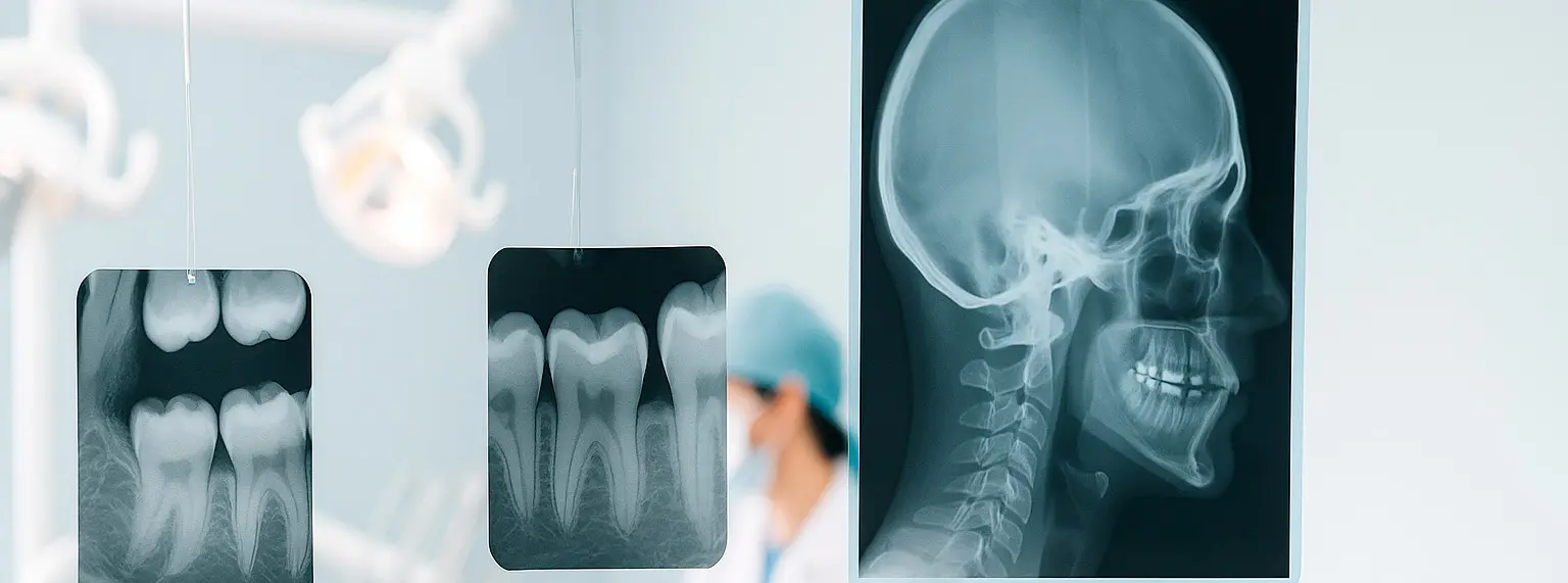 Análisis cefalométrico sobre telerradiografía lateral en RX San Miguel